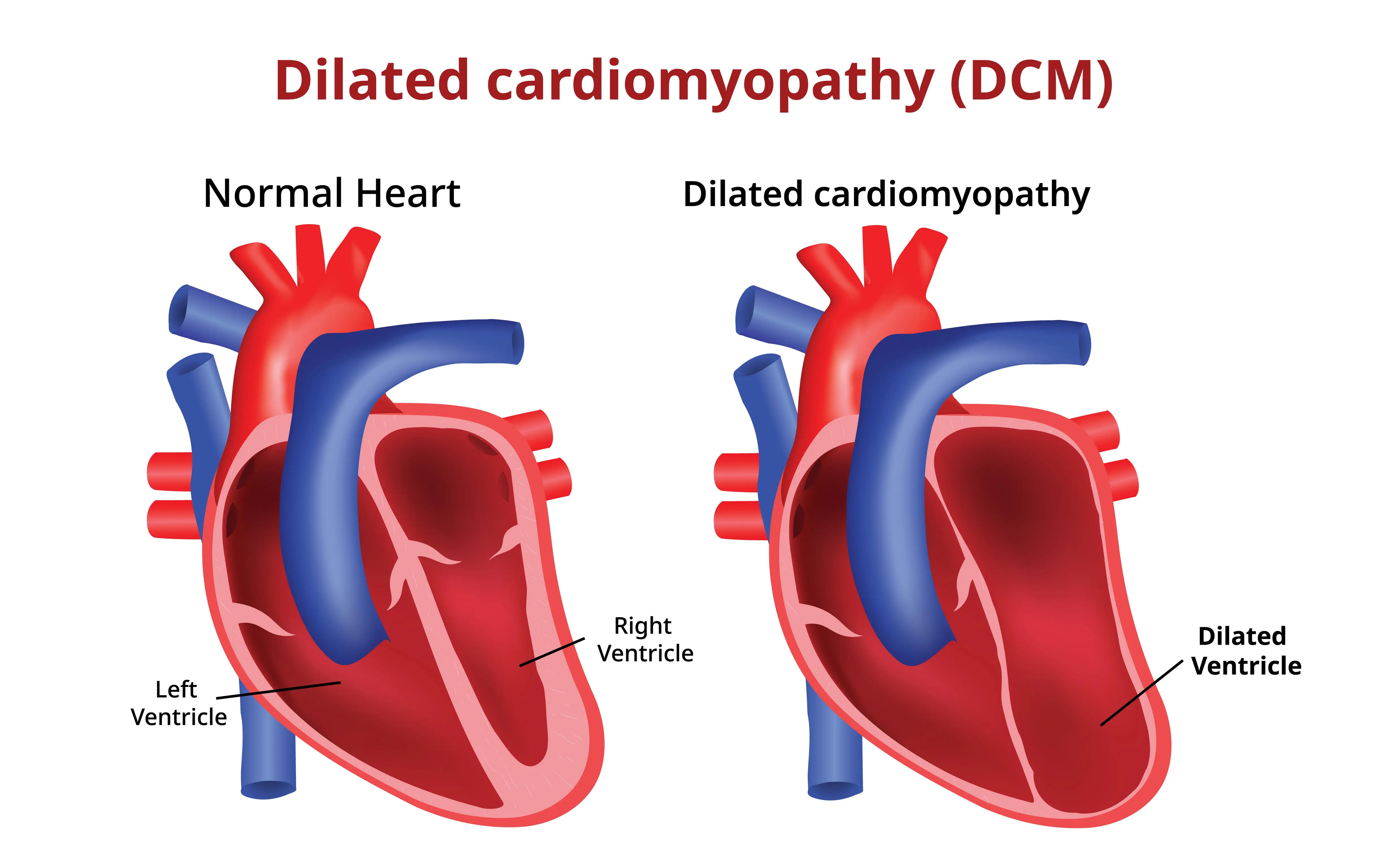 Understanding Dilated Cardiomyopathy: Symptoms and Treatment